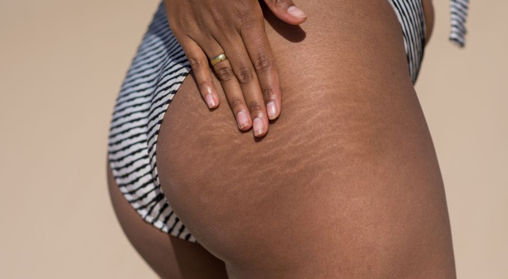 How To Treat Stretch Marks & Cellulite - By A Qualified Skin Expert