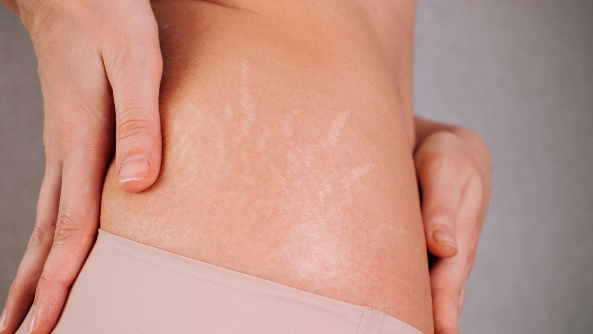 Microneedling for Radiant Skin: Stretch Marks, Scars & Sun Spots