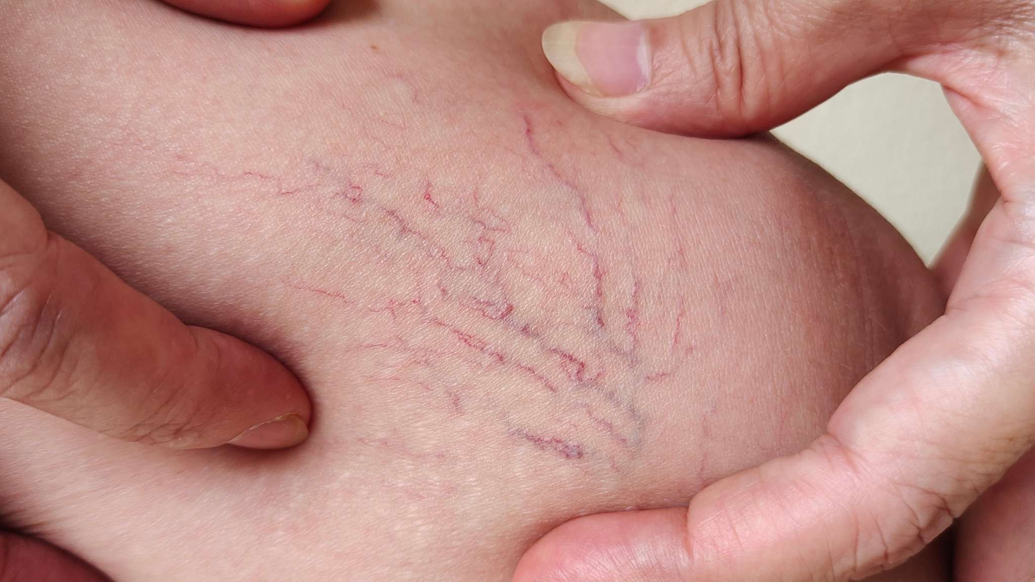 Understanding Thread Veins: Causes, Triggers & Treatment Options – BASE ...