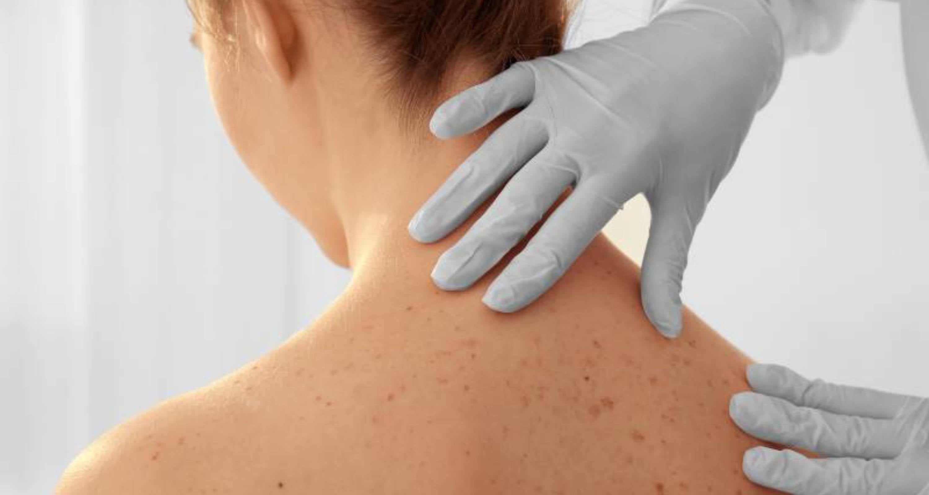 A simple way to quickly check your moles for skin cancer